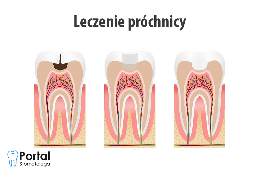 Leczenie próchnicy