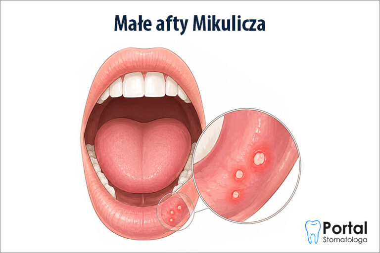Małe afty Mikulicza