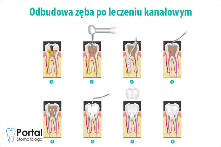 Odbudowa zęba po leczeniu kanałowym