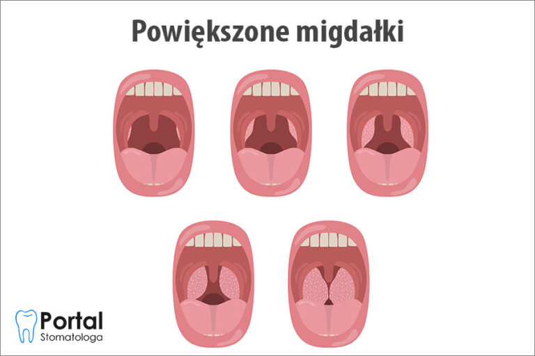 Powiększone migdałki