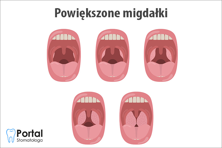 Powiększone migdałki