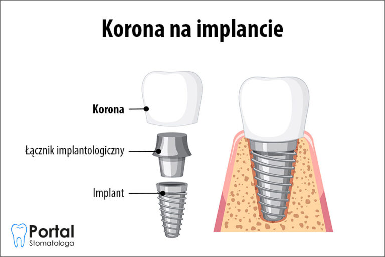 Korona na implancie