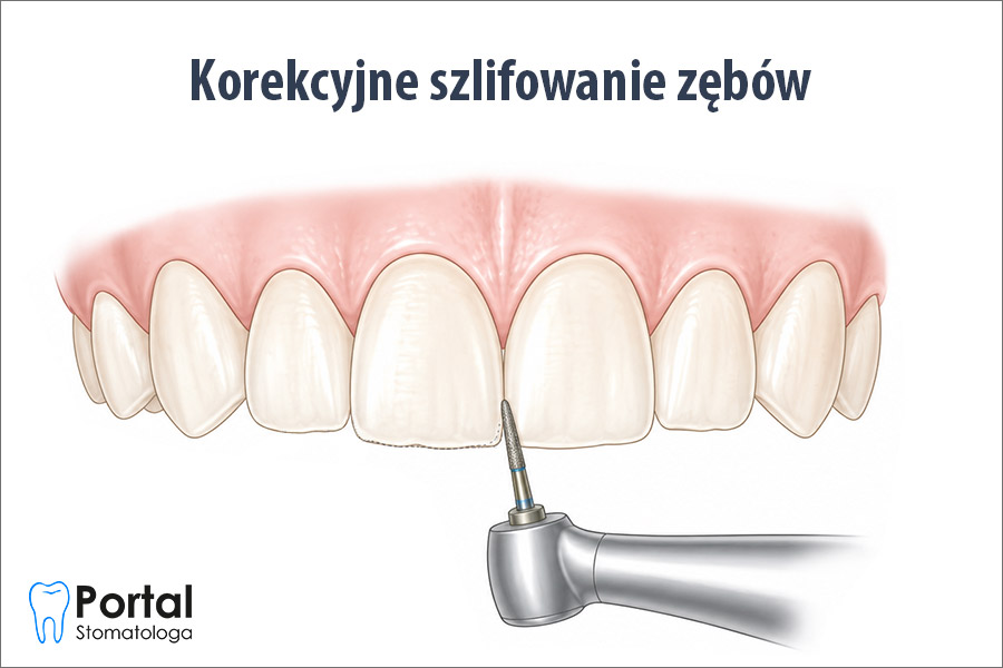 Korekcyjne szlifowanie zębów