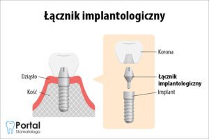 Łącznik implantologiczny