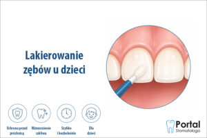 Lakierowanie zębów u dzieci
