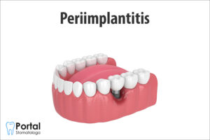 Periimplantitis