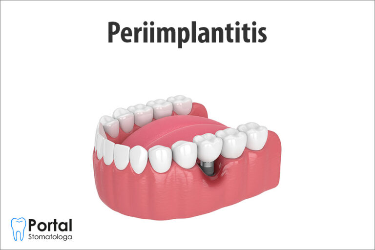 Periimplantitis