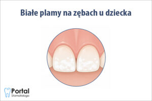Białe plamy na zębach u dziecka