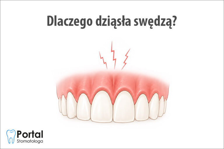 Dlaczego dziąsła swędzą?