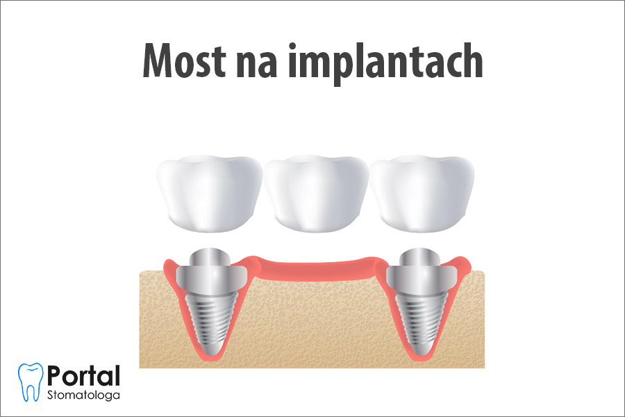 Most na implantach