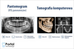Pantomogram a tomografia komputerowa