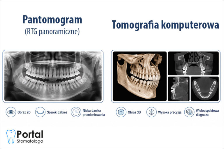 Pantomogram a tomografia komputerowa
