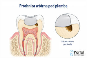Próchnica wtórna pod plombą