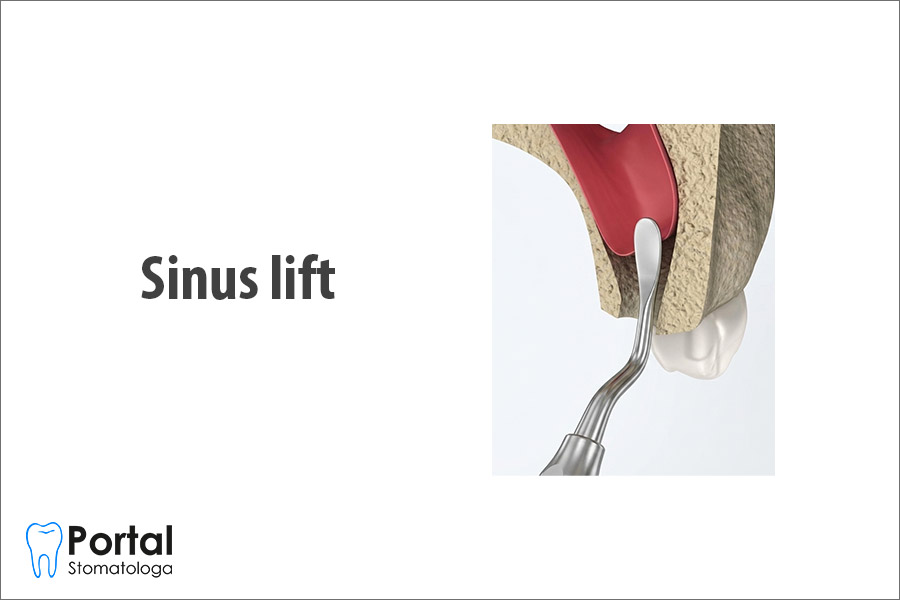 Sinus lift