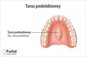 Torus podniebienny