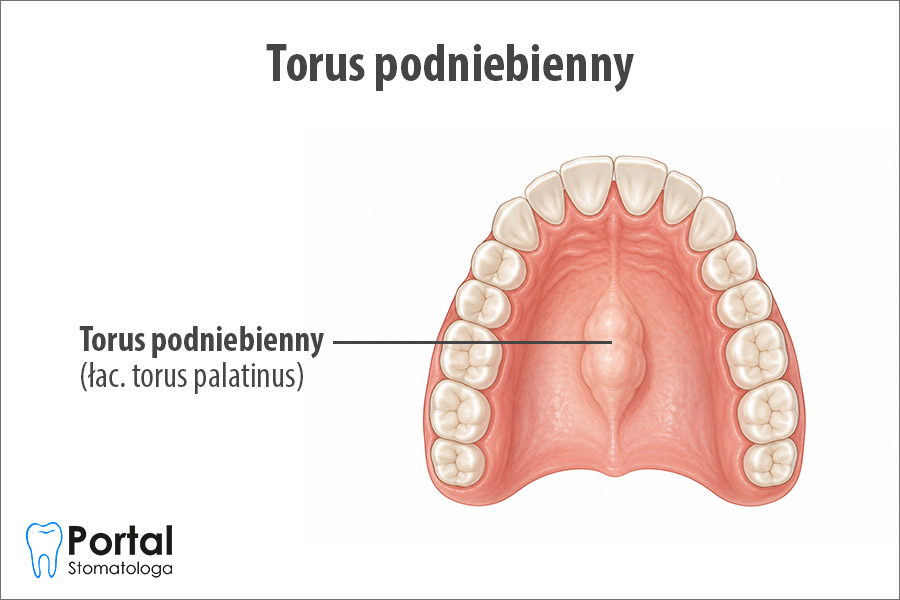 Torus podniebienny