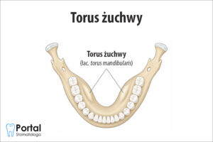 Torus żuchwy