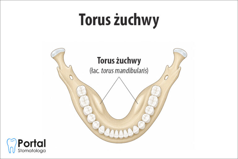 Torus żuchwy