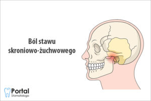 Ból stawu skroniowo-żuchwowego