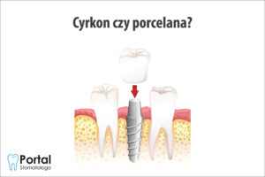 Cyrkon czy porcelana?