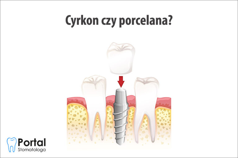 Cyrkon czy porcelana?