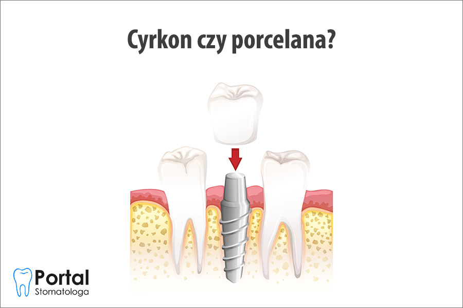Cyrkon czy porcelana?