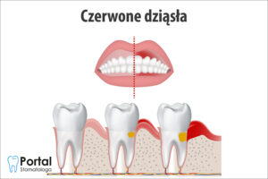 Czerwone dziąsła