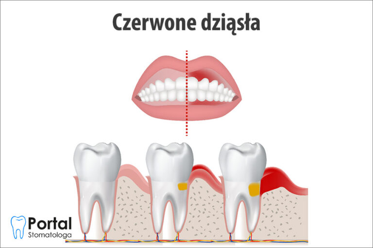 Czerwone dziąsła