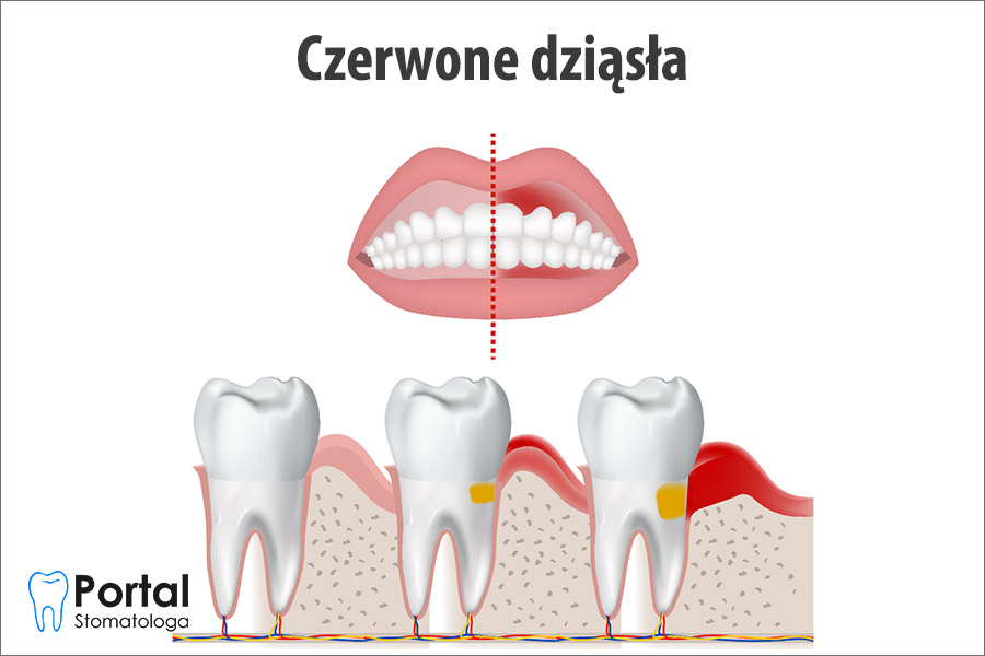 Czerwone dziąsła