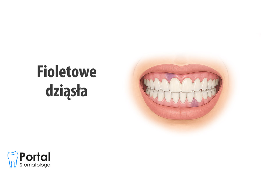 Fioletowe dziąsła