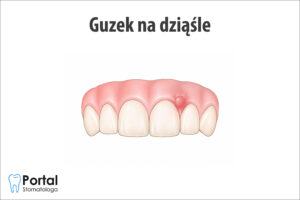 Guzek na dziąśle