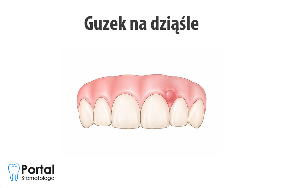 Guzek na dziąśle
