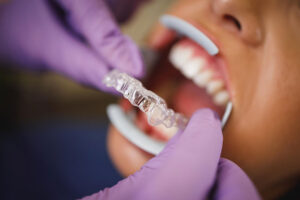 Invisalign czy aparat stały? Porównanie komfortu, higieny i przebiegu leczenia