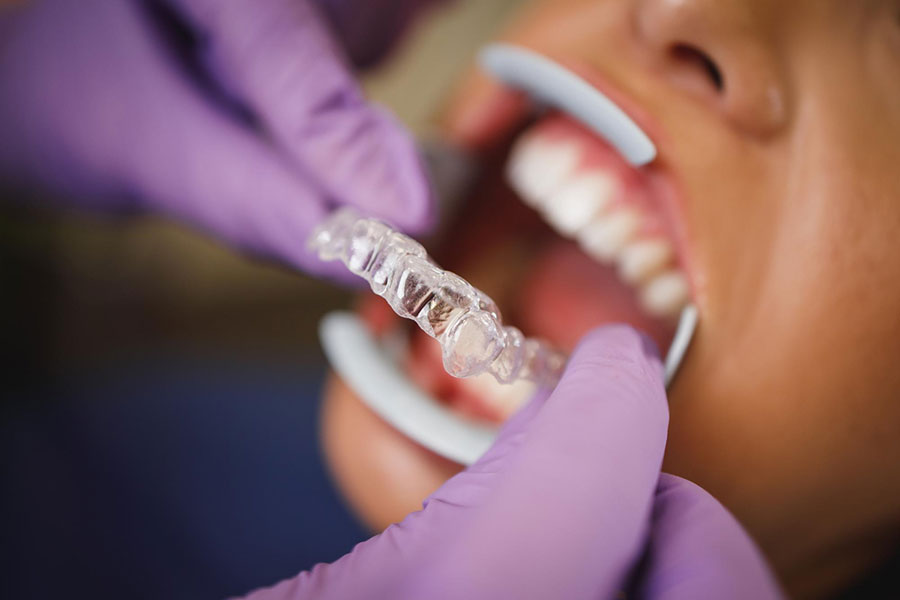 Invisalign czy aparat stały? Porównanie komfortu, higieny i przebiegu leczenia