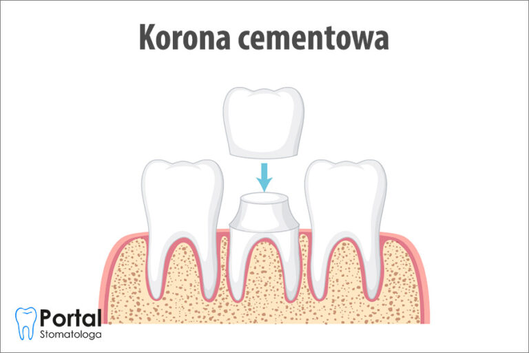 Korona cementowa