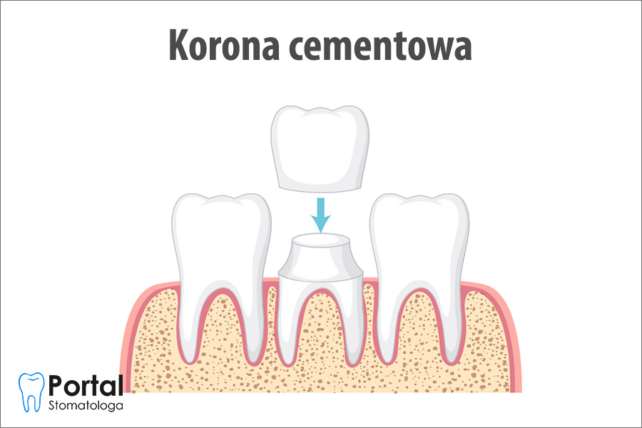 Korona cementowa