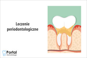 Leczenie periodontologiczne