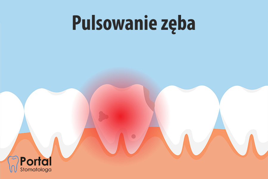 Pulsowanie zęba