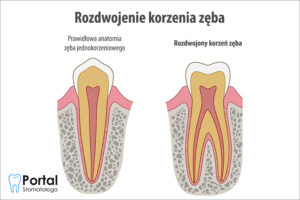 Rozdwojenie korzenia zęba