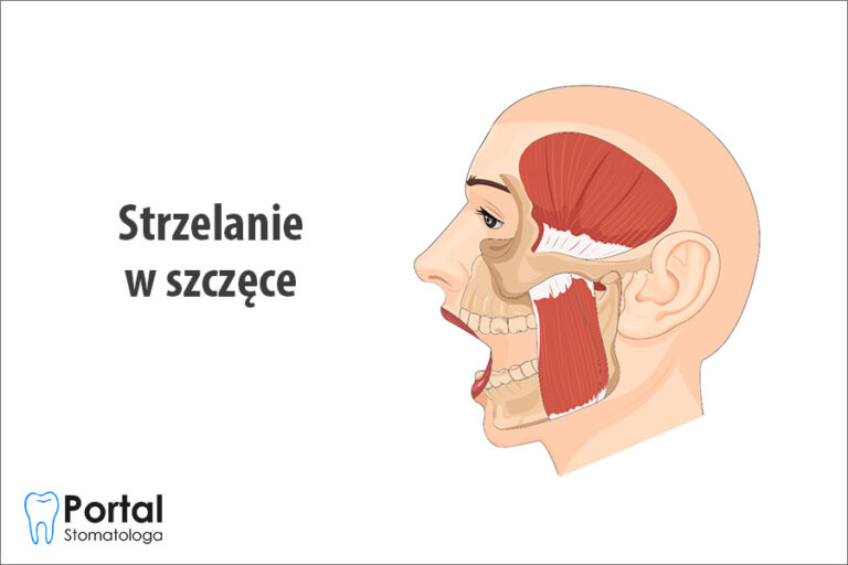 Strzelanie w szczęce