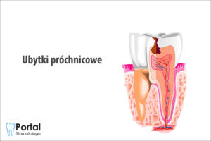 Ubytki próchnicowe