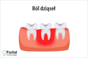 Ból dziąseł