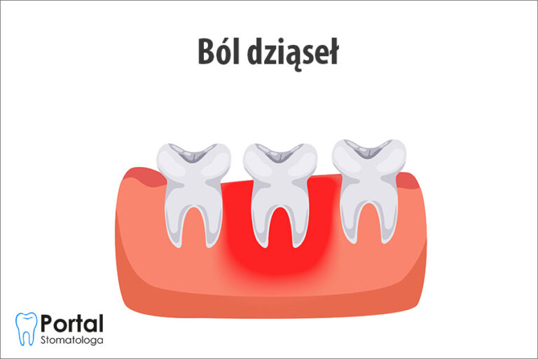 Ból dziąseł