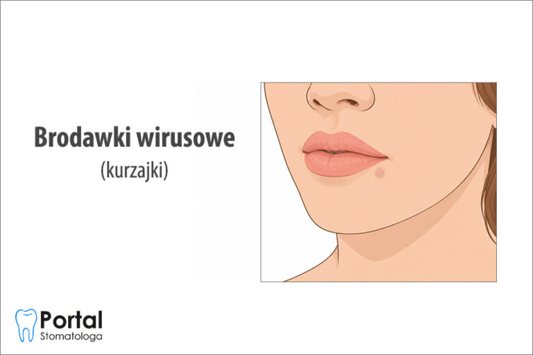 Brodawki wirusowe