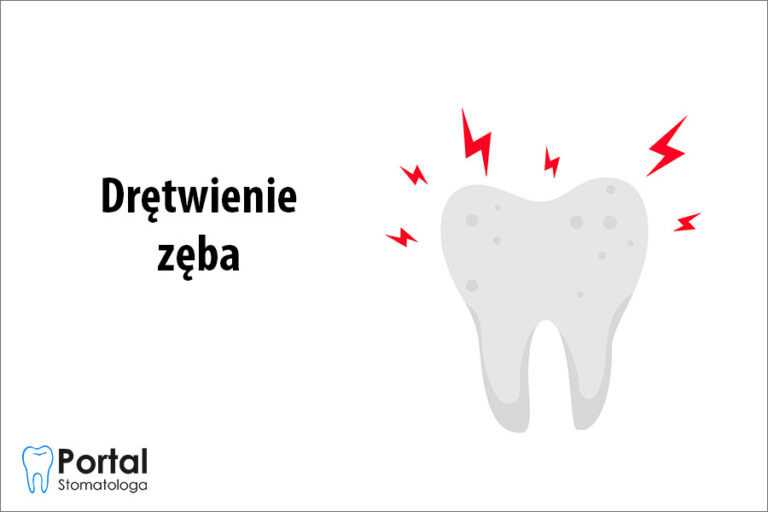 Drętwienie zęba