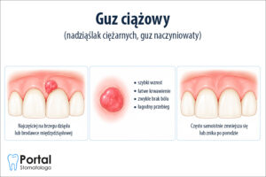 Guz ciążowy