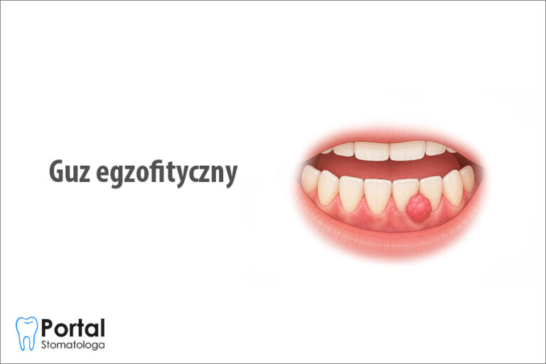 Guz egzofityczny
