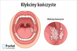 Kłykciny kończyste