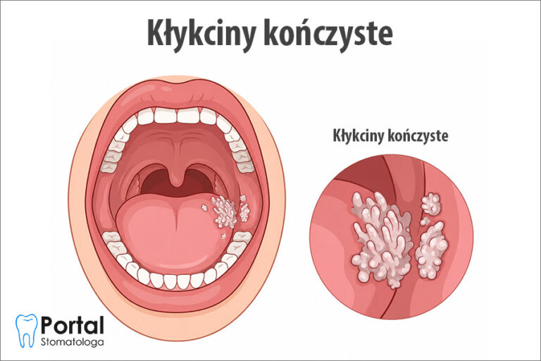 Kłykciny kończyste