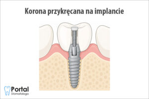 Korona przykręcana na implancie